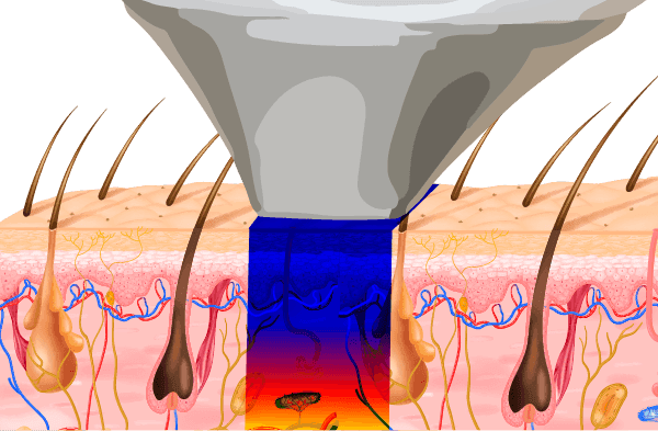 prof beauty laser